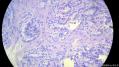 经典病例学习-甲状腺微小乳头状癌图16