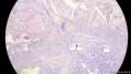 经典病例学习-甲状腺微小乳头状癌图2