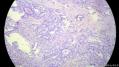 经典病例学习-甲状腺微小乳头状癌图7