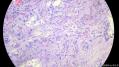 经典病例学习-甲状腺微小乳头状癌图15
