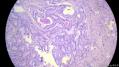 经典病例学习-甲状腺微小乳头状癌图9