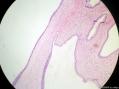 经典病例学习-宫颈CIN3累及腺体图4