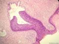 经典病例学习-宫颈CIN3累及腺体图6