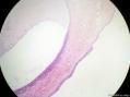 经典病例学习-宫颈CIN3累及腺体图5