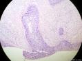 经典病例学习-宫颈CIN3累及腺体图2