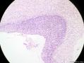 经典病例学习-宫颈CIN3累及腺体图1