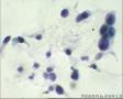 TCT5648请教。个人观点;HSIL,疑癌，累及腺体。活检结果：宫颈腺癌图3