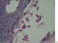 临床诊断急性阑尾炎，没见到中性粒细胞怎么报告？图4