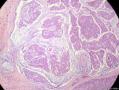 经典病例学习-乳腺粘液癌图2