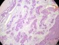 经典病例学习-乳腺粘液癌图9
