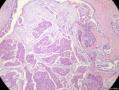 经典病例学习-乳腺粘液癌图3