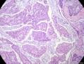 经典病例学习-乳腺粘液癌图4