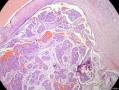经典病例学习-乳腺粘液癌图7