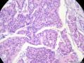 经典病例学习-乳腺粘液癌图5