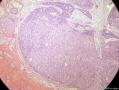 经典病例学习-乳腺粘液癌图1