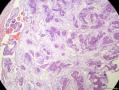 经典病例学习-乳腺粘液癌图12
