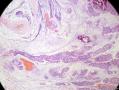 经典病例学习-乳腺粘液癌图10