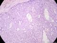 经典病例学习-乳腺粘液癌图15