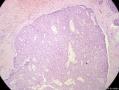 经典病例学习-乳腺粘液癌图14