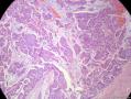 经典病例学习-乳腺粘液癌图13