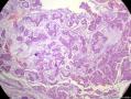经典病例学习-乳腺粘液癌图11