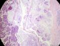 经典病例学习-乳腺粘液癌图8