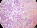 经典病例学习-乳腺粘液癌图6