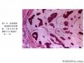 经典病例学习-乳腺粘液癌图19