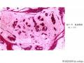 经典病例学习-乳腺粘液癌图20