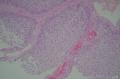 请教：膀胱肿物,细胞极向排列，非浸润性尿路上皮癌？图7