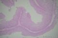 请教：膀胱肿物,细胞极向排列，非浸润性尿路上皮癌？图16