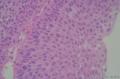 请教：膀胱肿物,细胞极向排列，非浸润性尿路上皮癌？图23