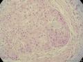 经典病例学习-腮腺粘液表皮样癌 (高级别)图8