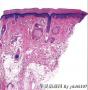 皮肤病理诊断线索：一例摘记图1