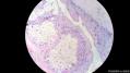 经典病例学习-皮脂腺囊瘤图5