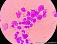 male 78 years old, pleural effusion, malignant cells?图3