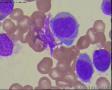 瑞氏染色，白血病细胞，大家看看像M几？图6