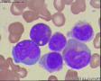 瑞氏染色，白血病细胞，大家看看像M几？图9