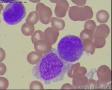 瑞氏染色，白血病细胞，大家看看像M几？图5