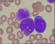 瑞氏染色，白血病细胞，大家看看像M几？图3