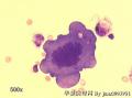 Pleural effusion, 66-year old female。 carcinoma cells?图6