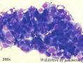 Pleural effusion, 66-year old female。 carcinoma cells?图8