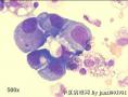 Pleural effusion, 66-year old female。 carcinoma cells?图7