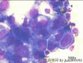 Pleural effusion, 66-year old female。 carcinoma cells?图3