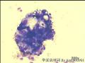 Pleural effusion, 66-year old female。 carcinoma cells?图2