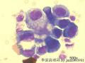 Pleural effusion, 66-year old female。 carcinoma cells?图5