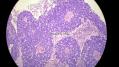 经典病例学习-视网膜母细胞瘤图20