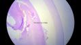 经典病例学习-视网膜母细胞瘤图9