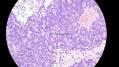 经典病例学习-视网膜母细胞瘤图21