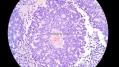 经典病例学习-视网膜母细胞瘤图23
